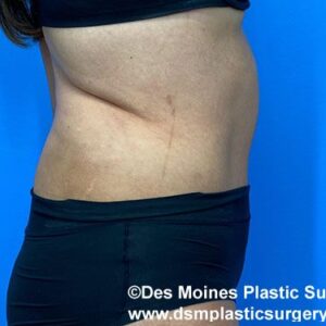 Tummy Tuck before and after photos