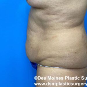 Tummy Tuck before and after photos