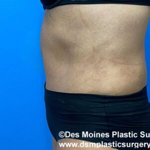 Tummy Tuck before and after photos