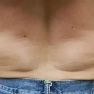 CoolSculpting before and after photos CoolSculpting before and after photos