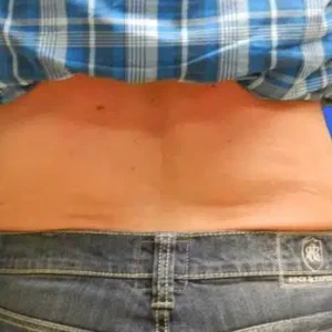 CoolSculpting before and after photos CoolSculpting before and after photos