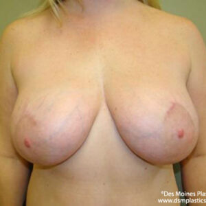 Breast Lift with Augmentation before and after photos