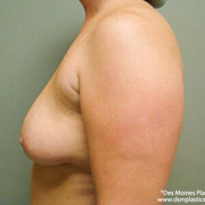 Breast Lift with Augmentation before and after photos