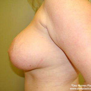 Breast Lift with Augmentation before and after photos