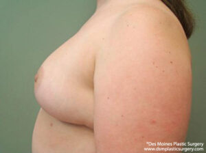 Breast Reduction before and after photos