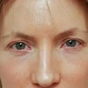 Brow Lift
