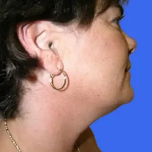 Neck Liposuction before and after photos