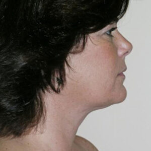 Neck Liposuction before and after photos