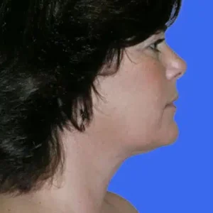 Neck Liposuction before and after photos