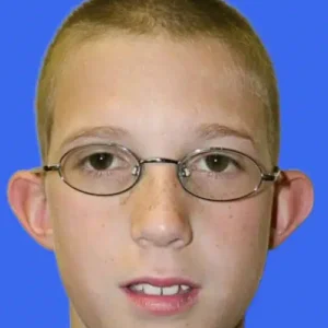 Ear Surgery before and after photos