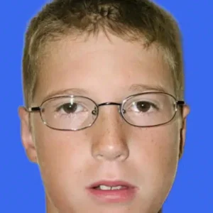 Ear Surgery before and after photos