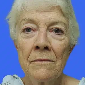 Face Lift before and after photos