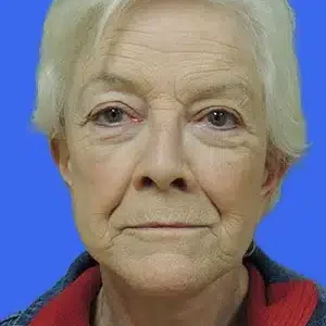 Face Lift before and after photos