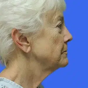 Face Lift before and after photos