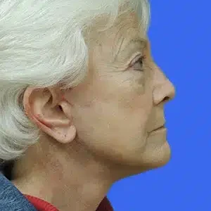 Face Lift before and after photos