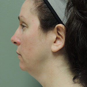 Laser Lift before and after photos