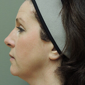 Laser Lift before and after photos