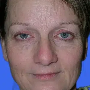 Rhinoplasty before and after photos