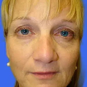 Rhinoplasty before and after photos