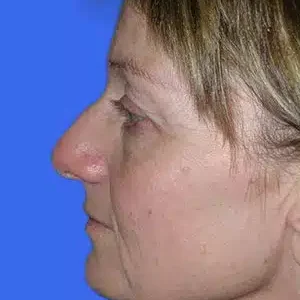 Rhinoplasty before and after photos