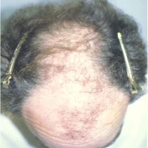 Neograft Hair Loss Replacement before and after photos