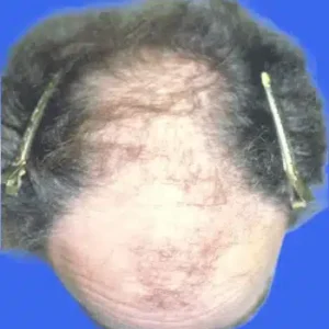 Neograft Hair Loss Replacement before and after photos
