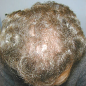 Neograft Hair Loss Replacement before and after photos