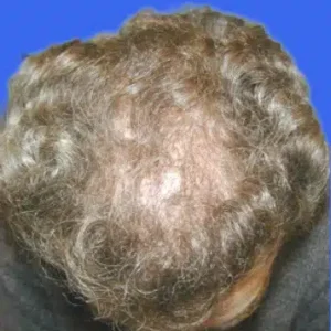 Neograft Hair Loss Replacement before and after photos