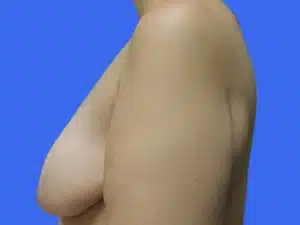 Breast Lift before and after photos Breast Lift before and after photos