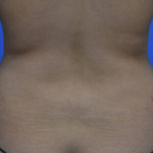 Liposuction before and after photos