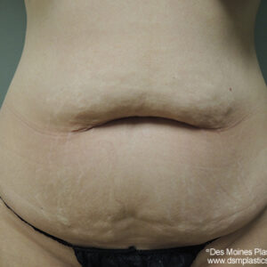 Tummy Tuck before and after photos