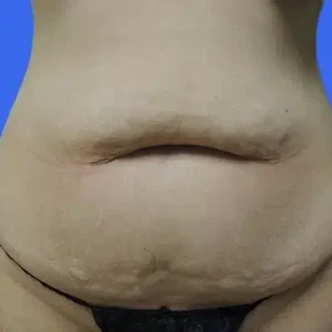 Tummy Tuck before and after photos Tummy Tuck before and after photos