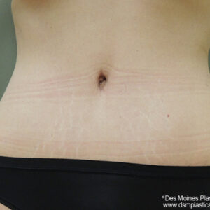 Tummy Tuck before and after photos