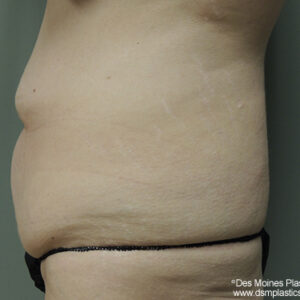 Tummy Tuck before and after photos