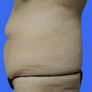 Tummy Tuck before and after photos Tummy Tuck before and after photos