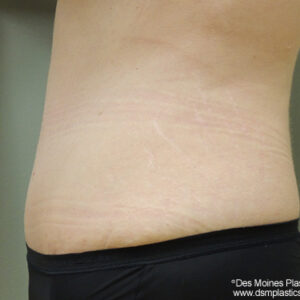 Tummy Tuck before and after photos
