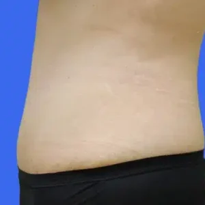 Tummy Tuck before and after photos Tummy Tuck before and after photos