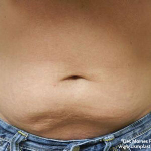 CoolSculpting before and after photos