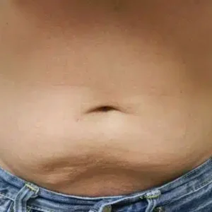 CoolSculpting before and after photos CoolSculpting before and after photos