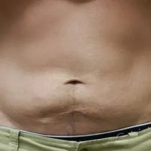 CoolSculpting before and after photos CoolSculpting before and after photos