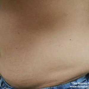 CoolSculpting before and after photos