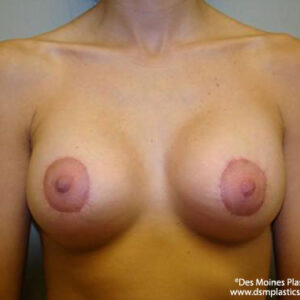 Breast Lift with Augmentation before and after photos