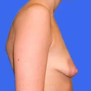 Breast Lift with Augmentation before and after photos