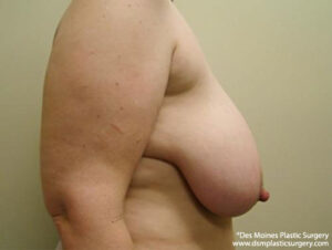 Breast Reduction before and after photos