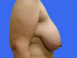 Breast Reduction before and after photos