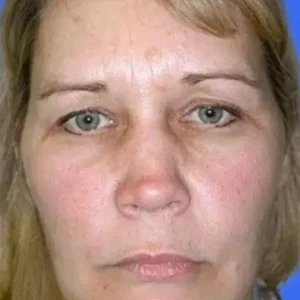 Brow Lift before and after photos