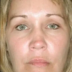 Brow Lift before and after photos