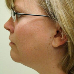 Neck Liposuction before and after photos