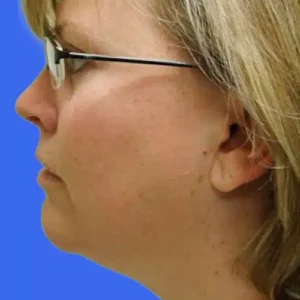 Neck Liposuction before and after photos