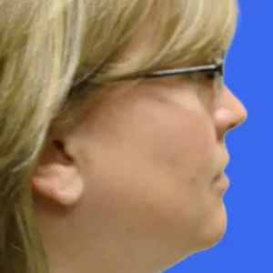 Neck Liposuction before and after photos